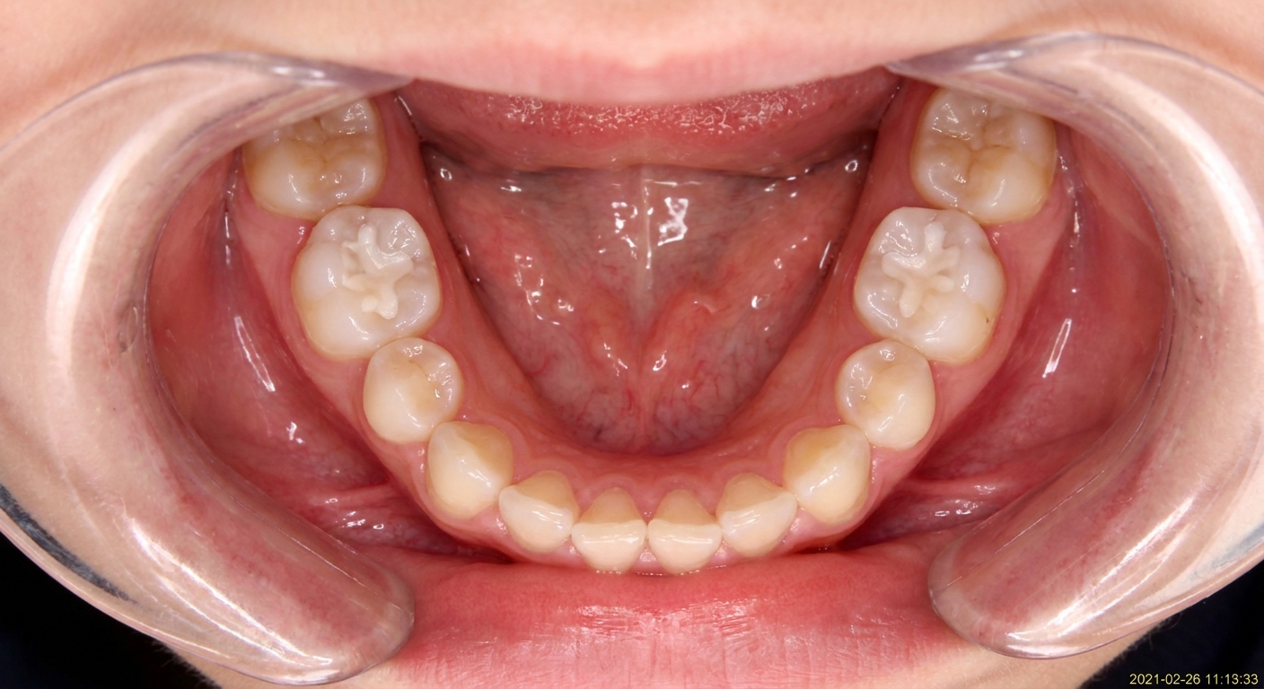 Intraoral occlusal photo from Mia's last visit